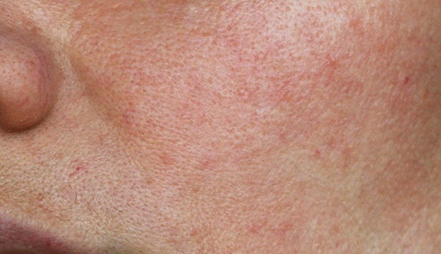 Skin barrier repair